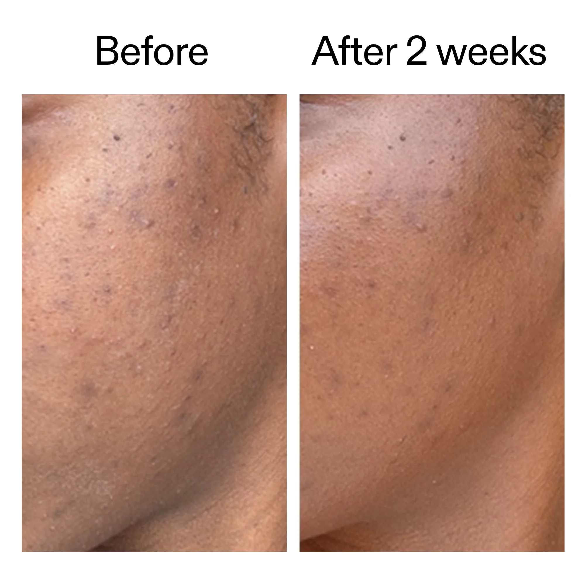 360° Acne Clearing Duo - Image 6
