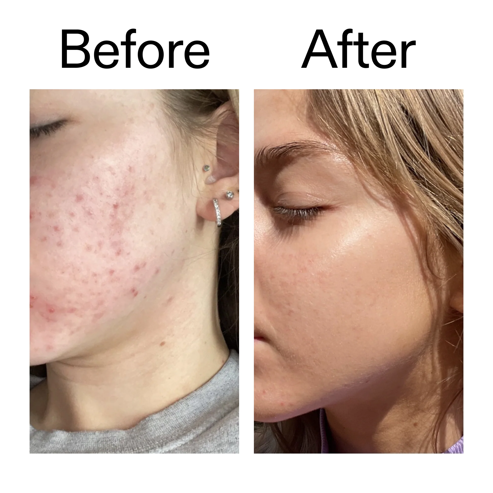 Beta Hydroxy Acid (BHA) Serum - Image 8