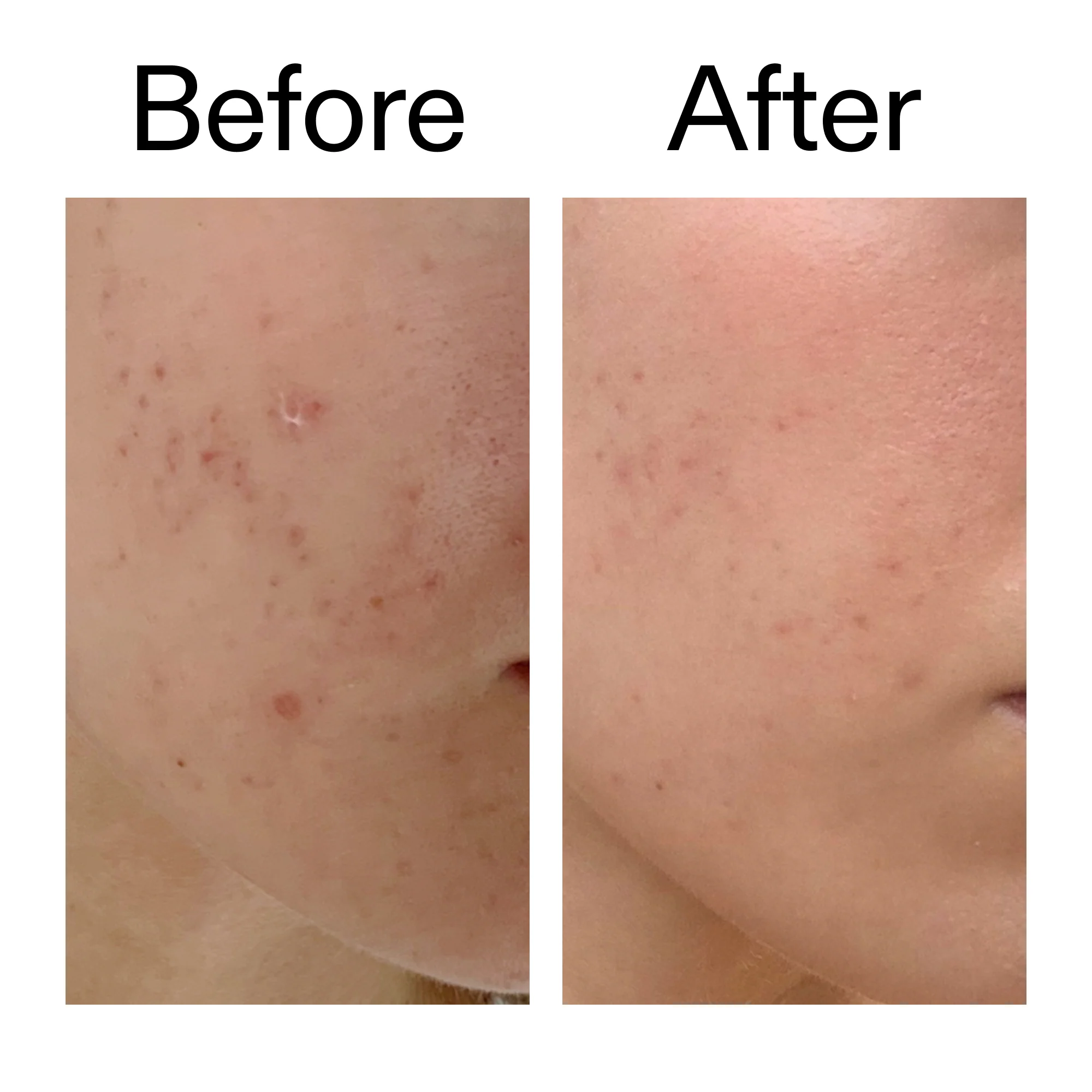 Mandelic Acid Treatment - Image 10