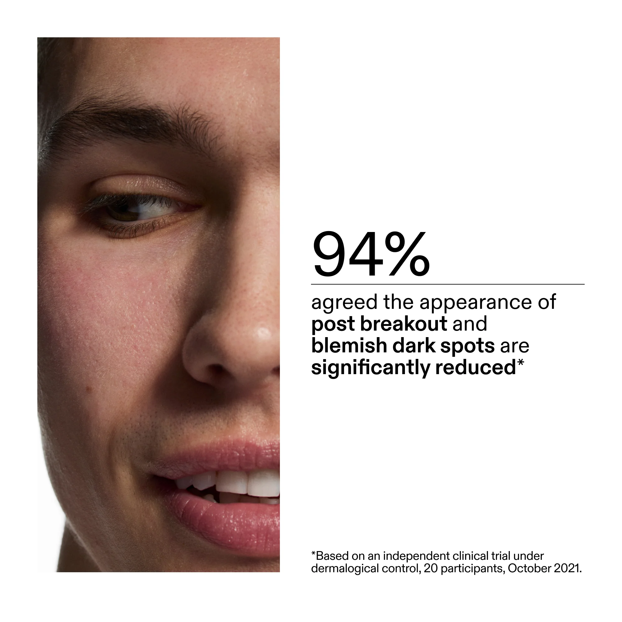 Mandelic Acid Treatment - Image 6