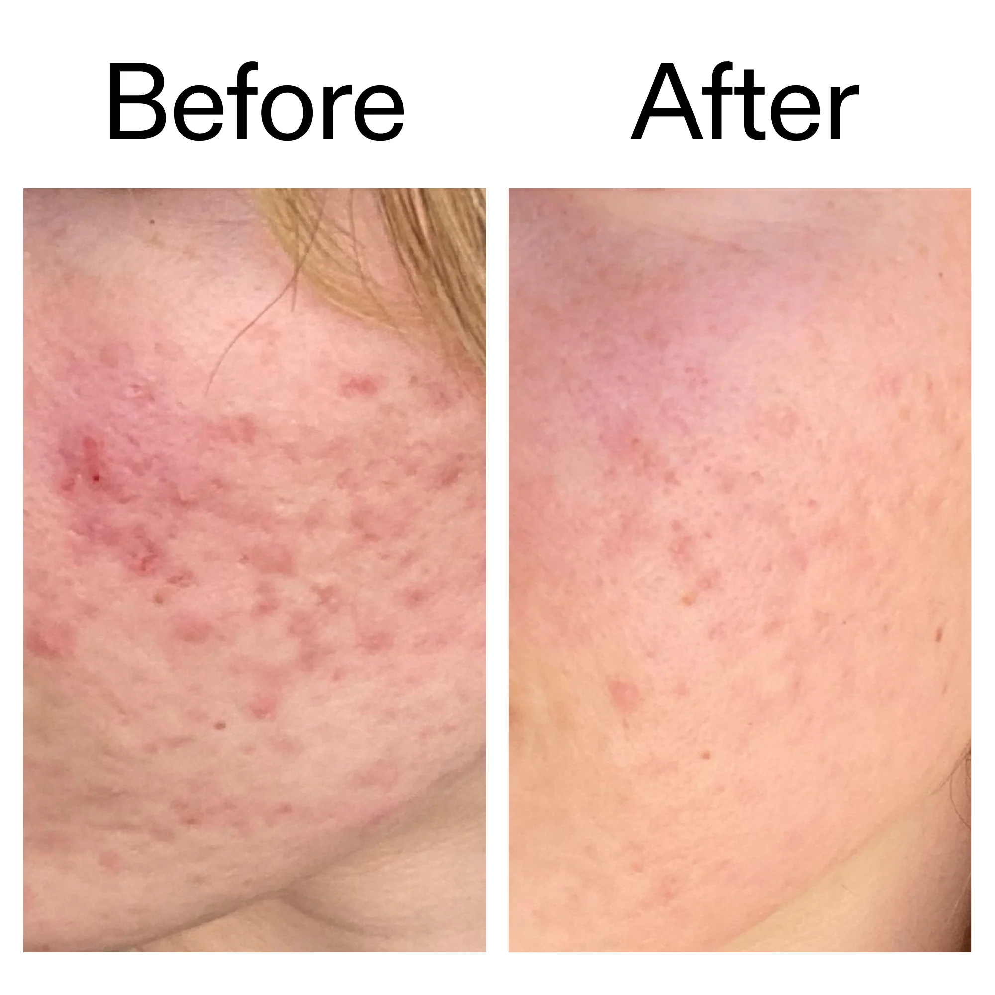 10% Azelaic Acid Serum for Redness Relief - Image 10