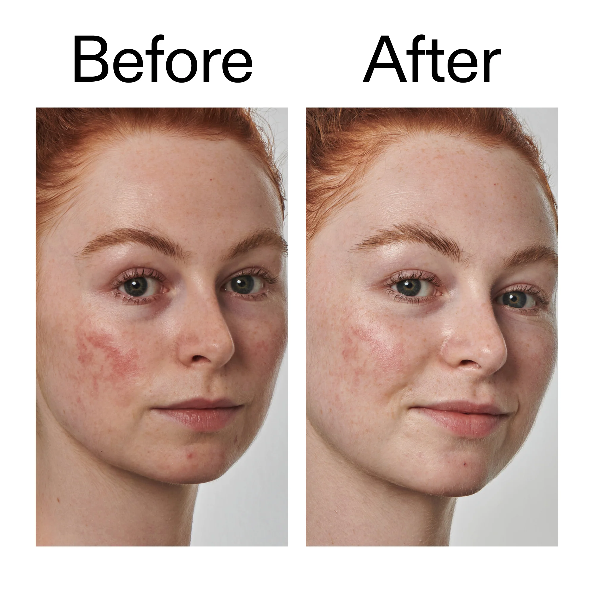 10% Azelaic Acid Serum for Redness Relief - Image 9