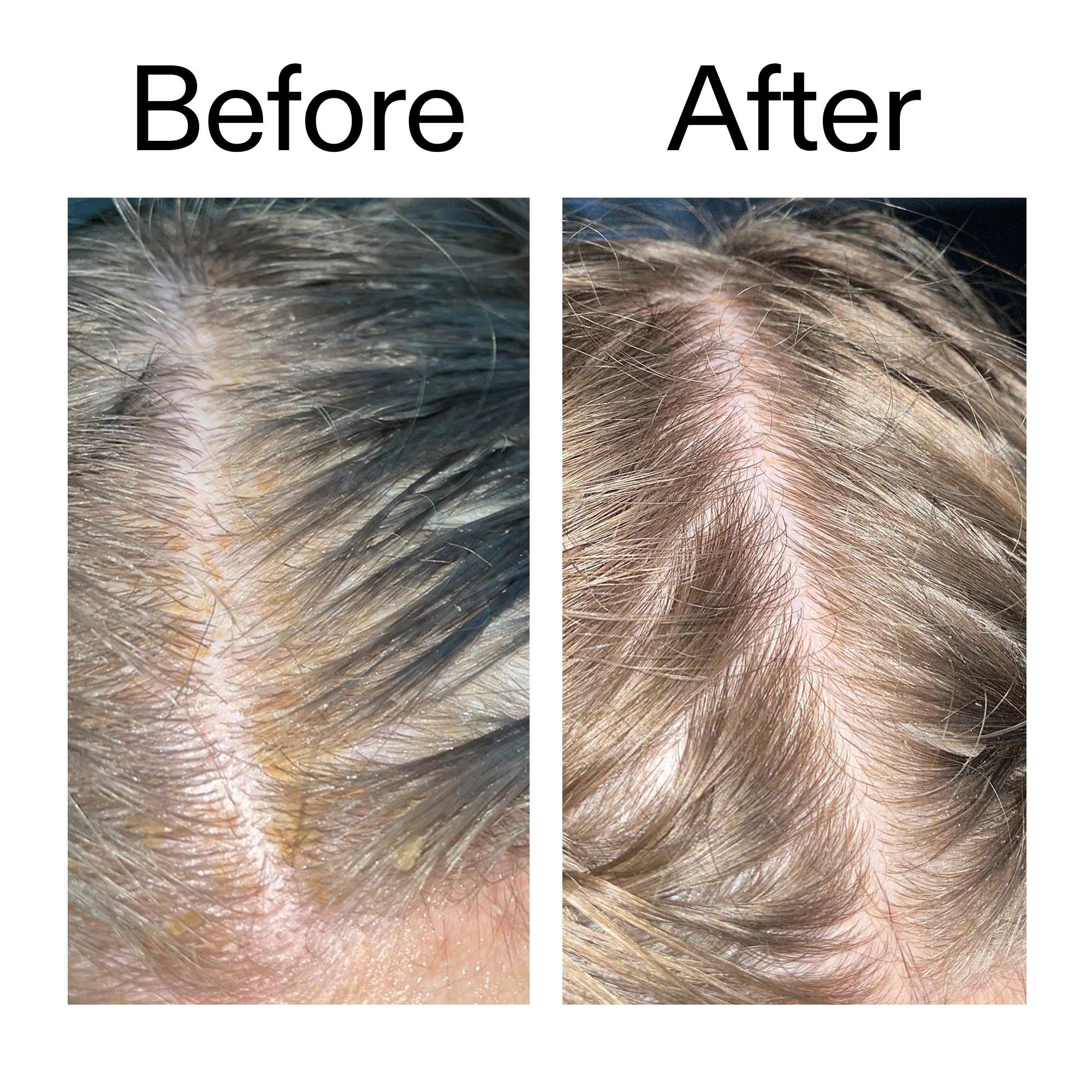 Salicylic Acid Exfoliating Scalp Treatment - Image 10