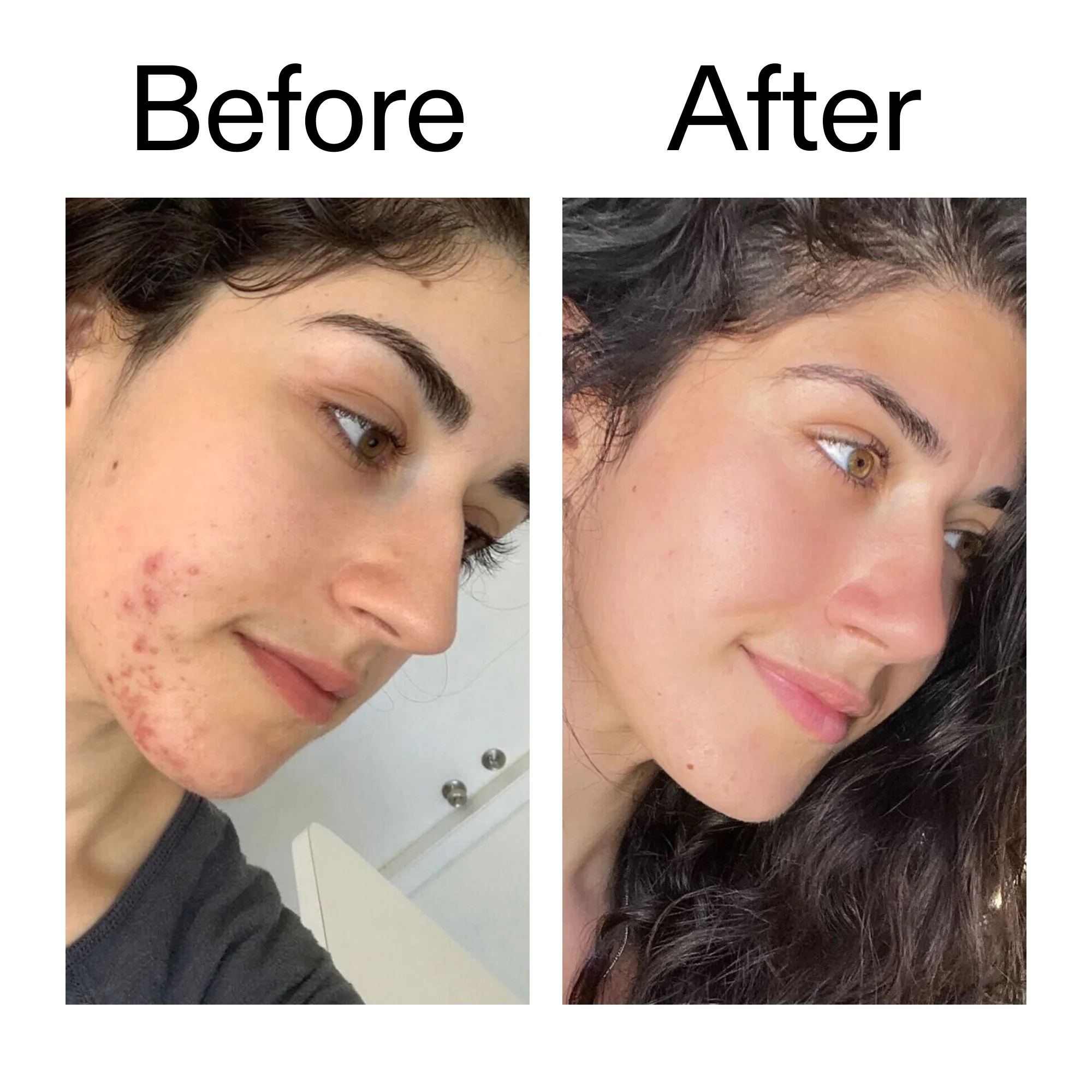 Succinic Acid Acne Treatment - Image 10