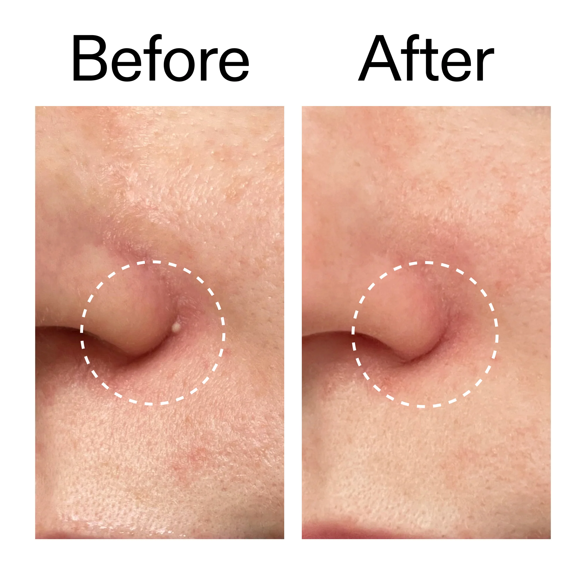 Hydrocolloid Invisible Pimple Patches - Pack of 22 - Image 9